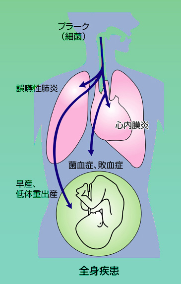 歯周病は、お口の中以外にもさまざまな影響を与えます