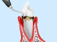 歯周病治療