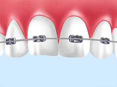 歯列矯正（矯正歯科）