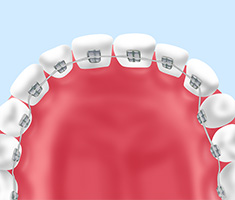 リンガルブラケット（舌側矯正）