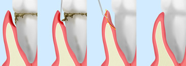 歯周ポケット掻爬（そうは）術